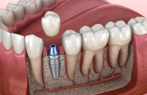 dental-implants-hampshire