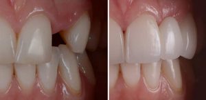 implants-in-andover